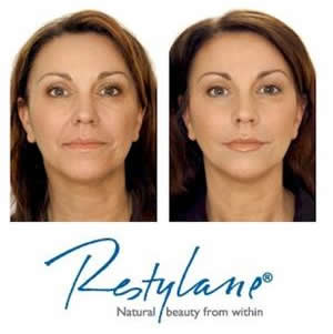 nasoloabial smile line fillers Mendham New Jersey